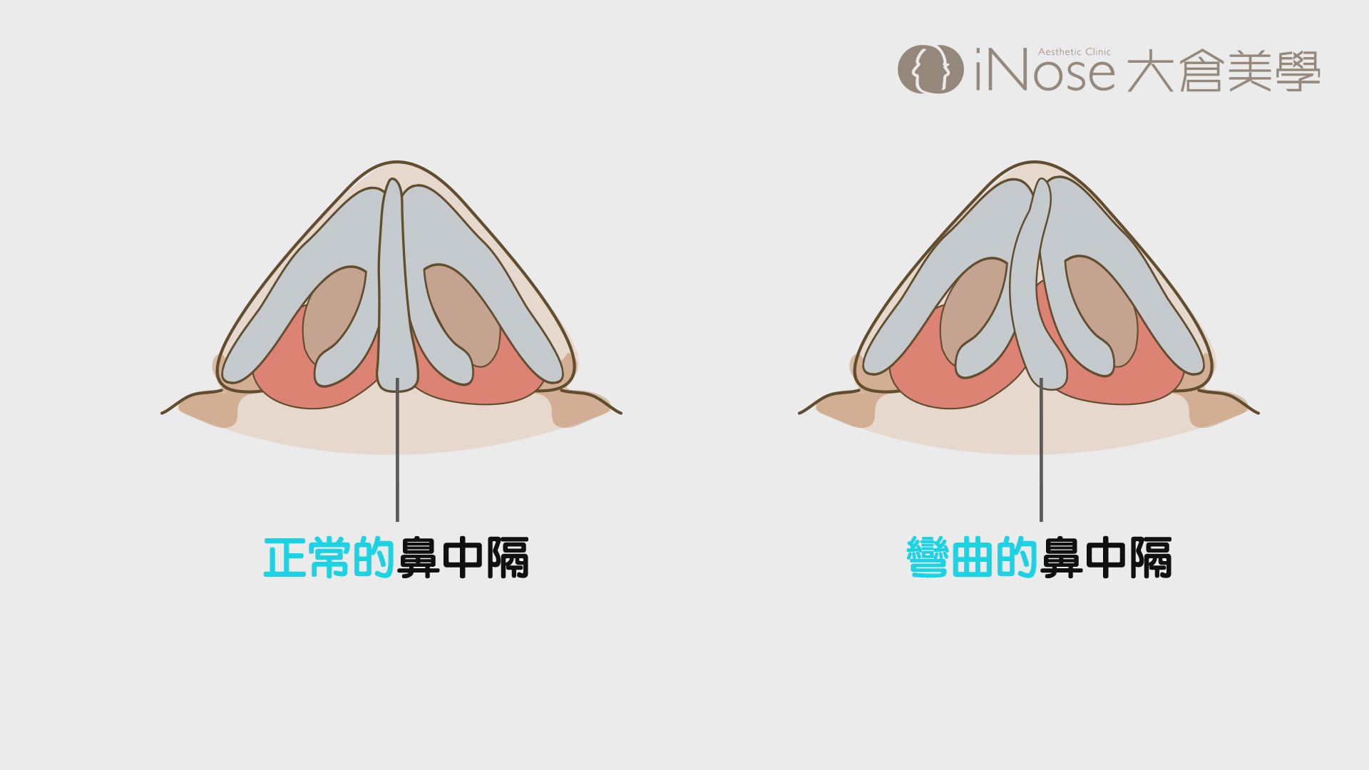 精緻鼻中隔彎曲矯正手術 大師美學