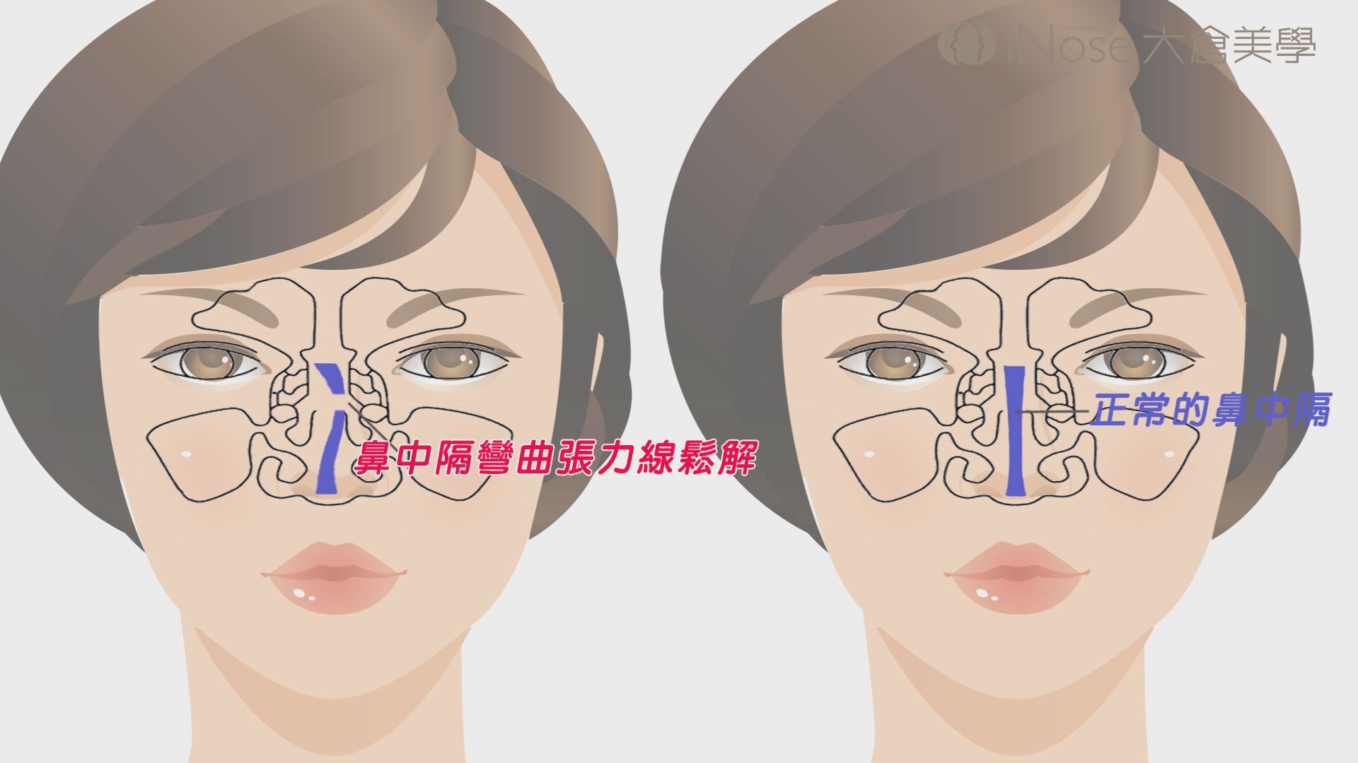 精緻鼻中隔彎曲矯正手術 大師美學