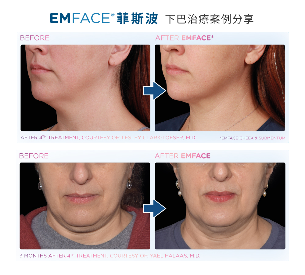 EMFACEA2
