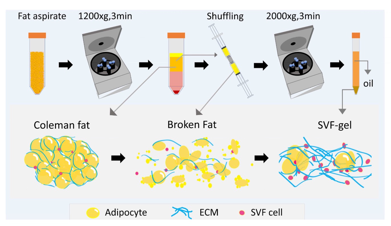 貴妃膠 SVF-ECM自體脂肪細胞膠：自体脂肪移植v3.0 - 大師美學