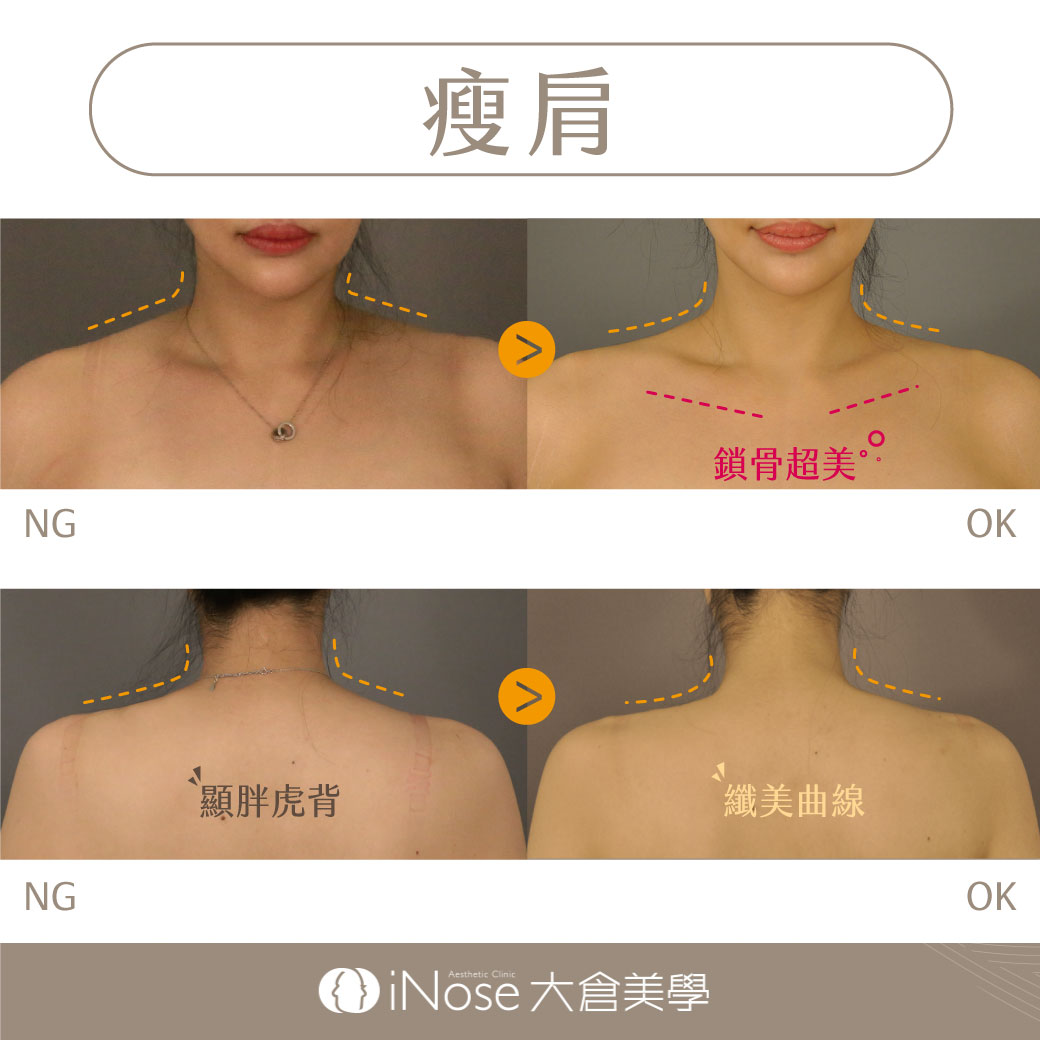 Bye Bye 女漢子 自信露香肩 瘦肩 針 大師美學