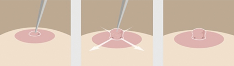 乳頭乳暈美形術 乳頭凹陷矯正手術 纜線支撐法