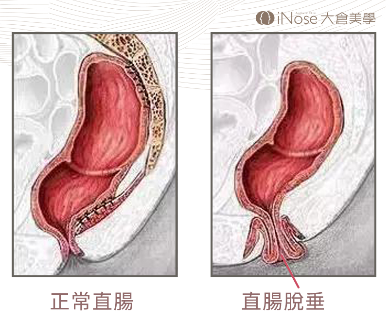 盆底肌新知分享直腸脫垂1