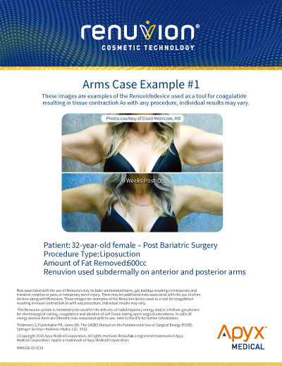 Renuvion Arms Case 1
