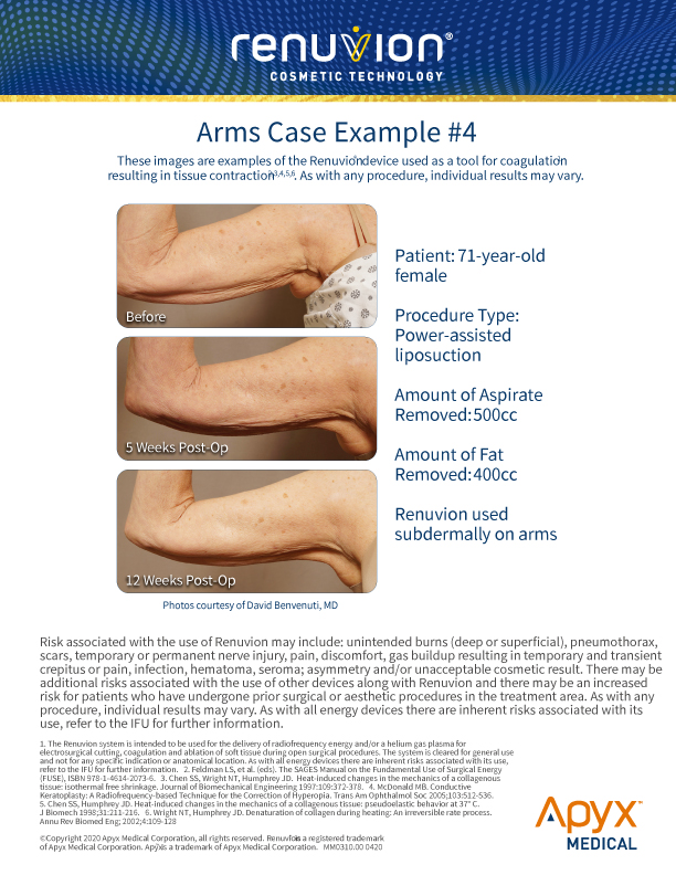 Renuvion Arms Case 4